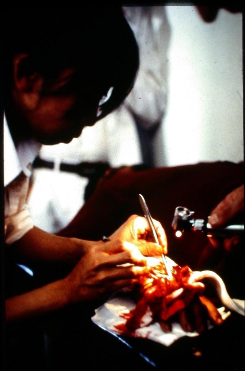 1982年在夏蒂拉营的加沙医院,洪瑞钗在没有面罩、手套、麻醉药和电力供应的情况下,为伤者动手术。(受访者提供)