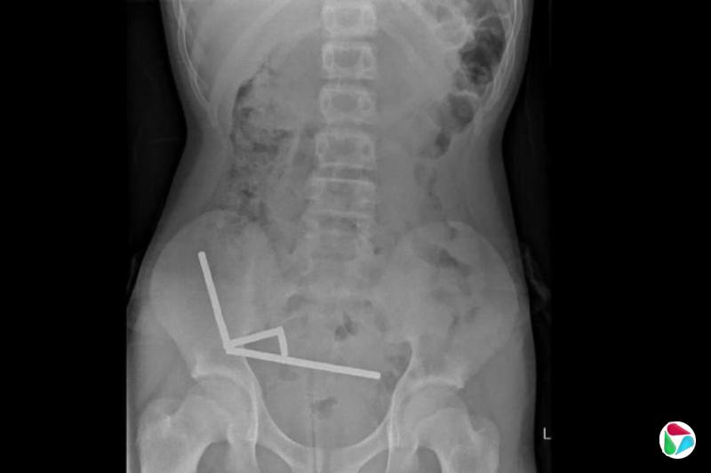 新西兰男童吞百片网购磁铁 肠道部分组织坏死